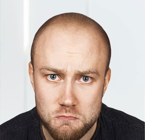 HAIR TRANSPLANT